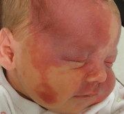 Port-wine stain (nevus flammeus) on newborn face - flat pink/purple lesion in trigeminal V1/V2 distribution