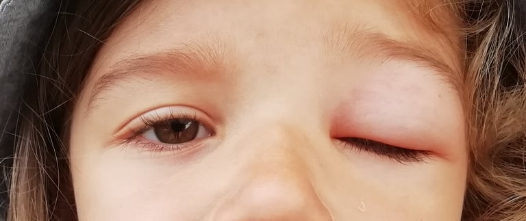 Комар укусил в глаз 