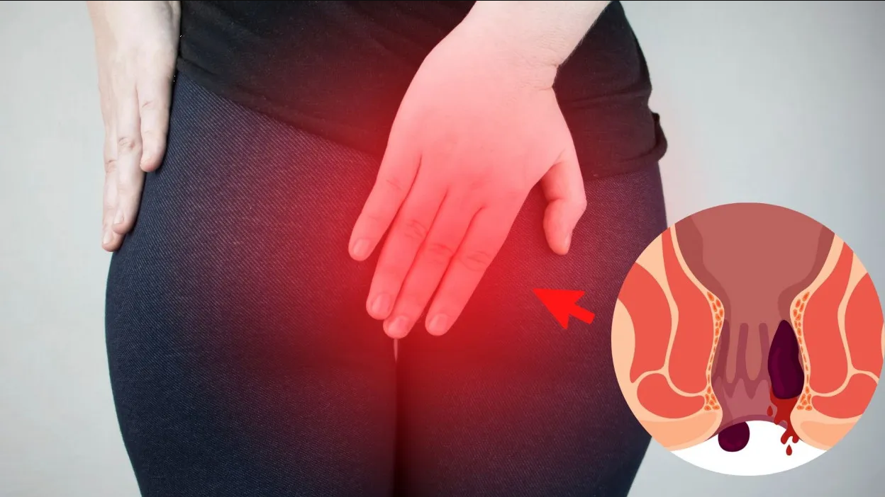 Me salió una bolita en el ano, ¿qué puede ser?