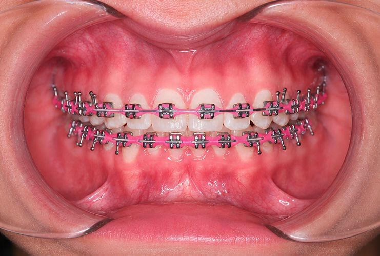 Instalación de Brackets