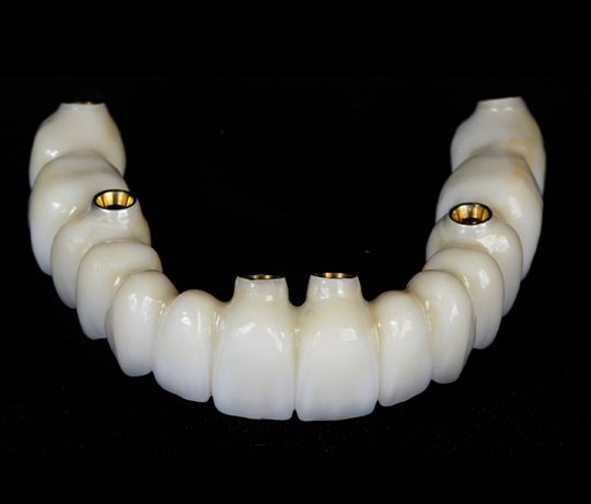 Full Arch Implant (FMR using Implants)
