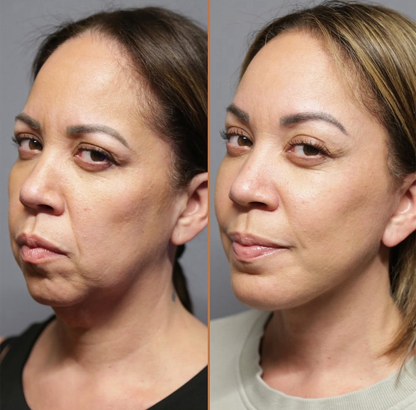 Résultat — traits détendus