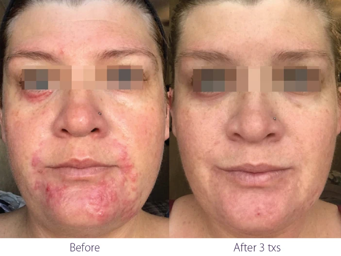 ClearLift before and after result at Let's Face It Med Spa in Denver.