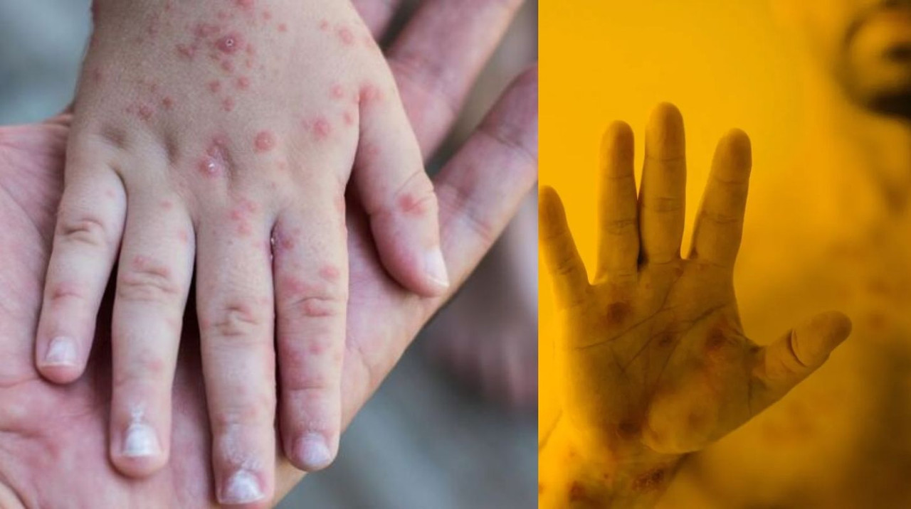 ¿Cómo se contagia la viruela del mono?