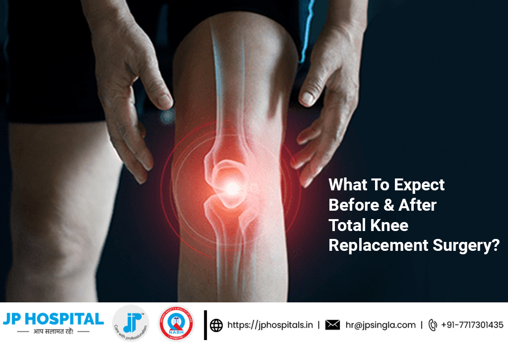 What to Expect Before & After Total Knee Replacement Surgery? by Jp