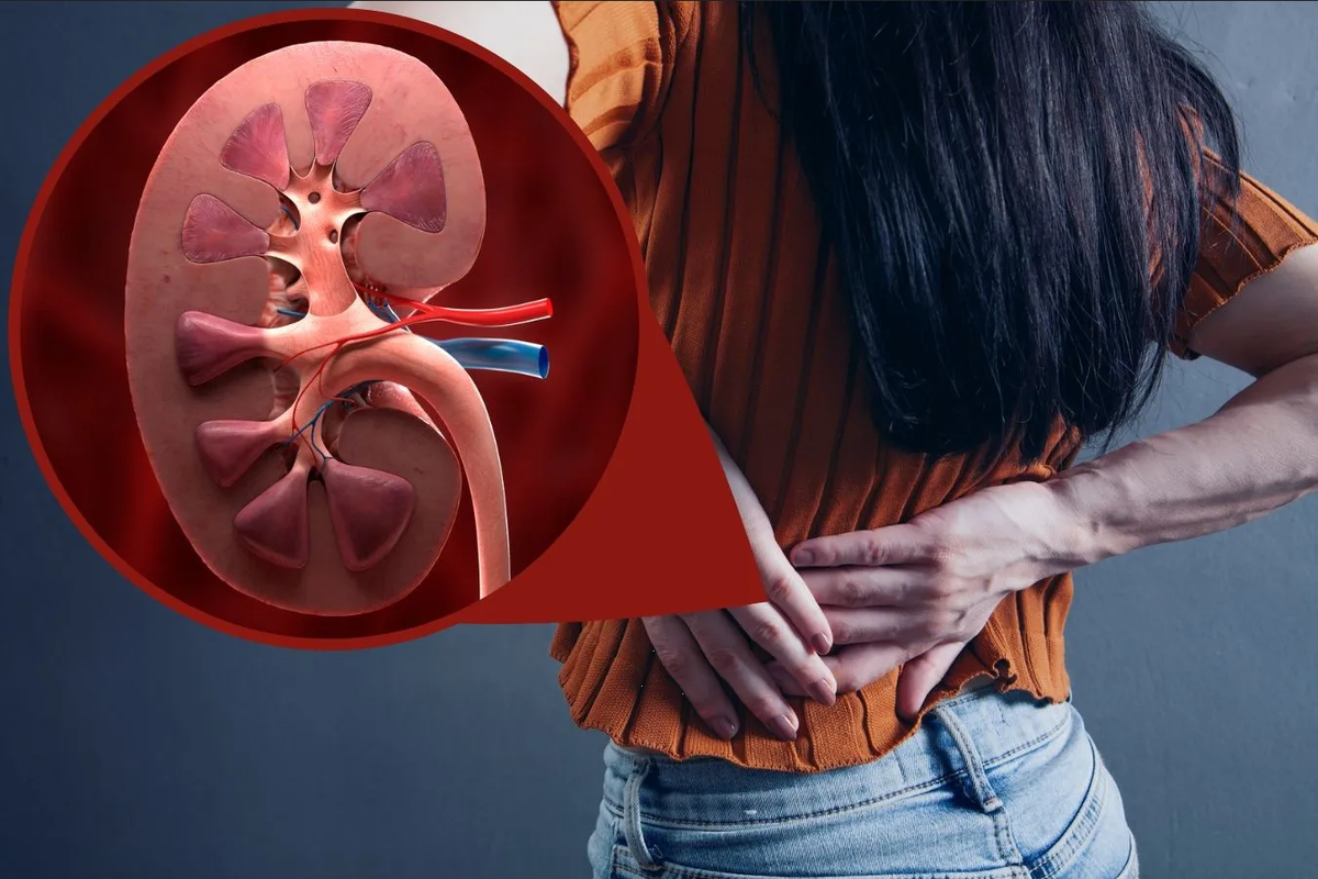 Alivio del dolor en riñones y eliminación de piedras renales con una hierba