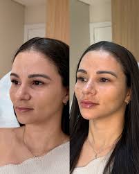 Preenchimento Queixo