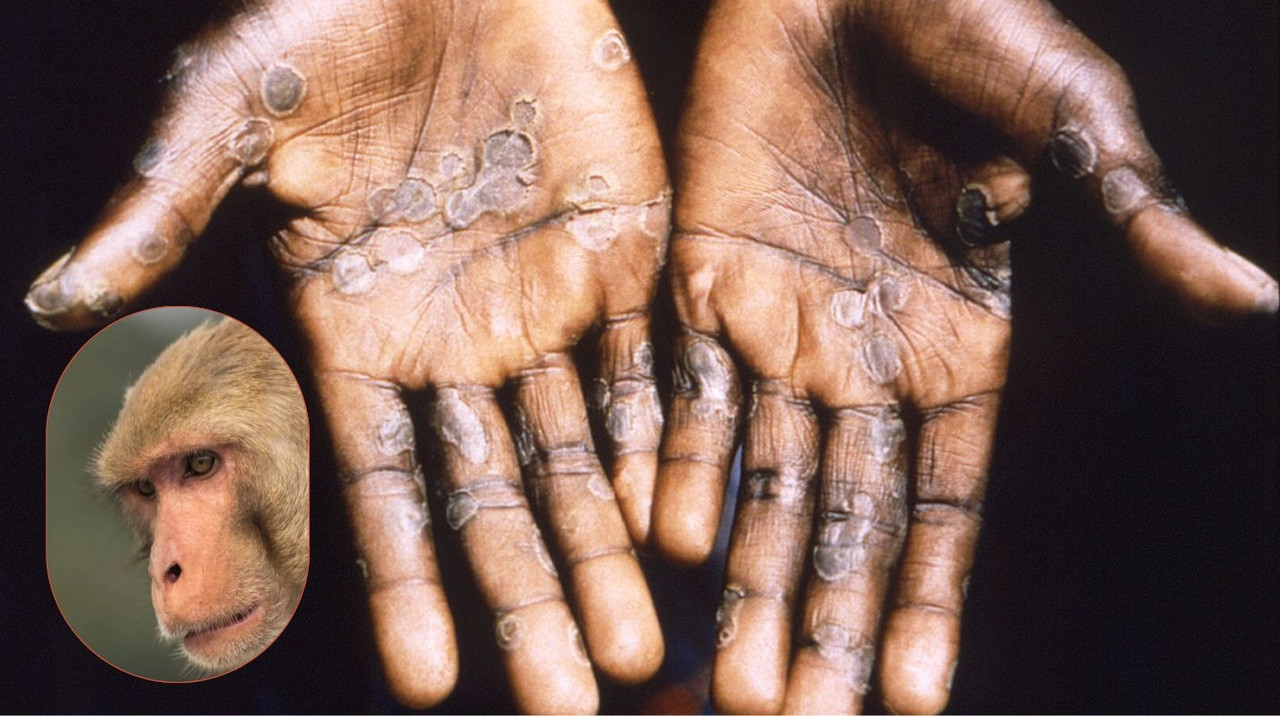 Origen de la viruela del mono