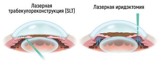 Лазерная иридотомия (иридэктомия) при глаукоме