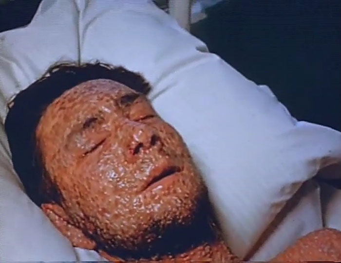 smallpox