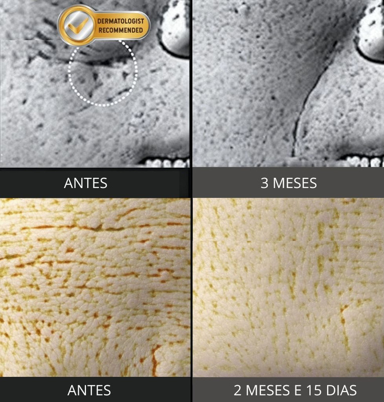 Antes e depois Liverinol