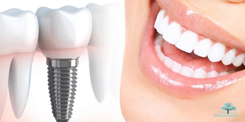 Dental Implants Feel and Look Natural