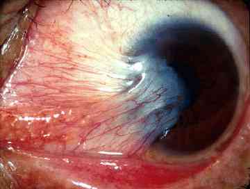 Ophthalmology question 8 image