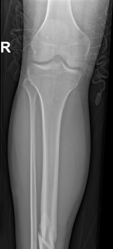 18 12 25 koleno ap d