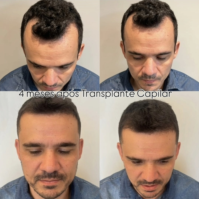 Resultado de transplante capilar 6