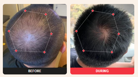 Before and during routine-use examples showing hair density progress