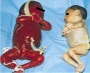 Twin-twin transfusion syndrome - live twins: recipient polycythemic (plethoric/ruddy), donor anemic (pale)