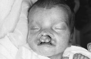 Bilateral cleft lip deformity - complete bilateral clefts, protruding premaxilla, flattened nasal tip
