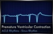 premature ventricular contraction