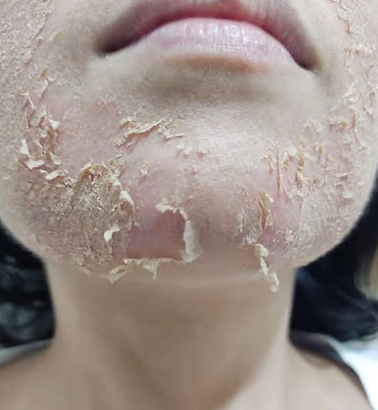 Pele renovada apos peeling
