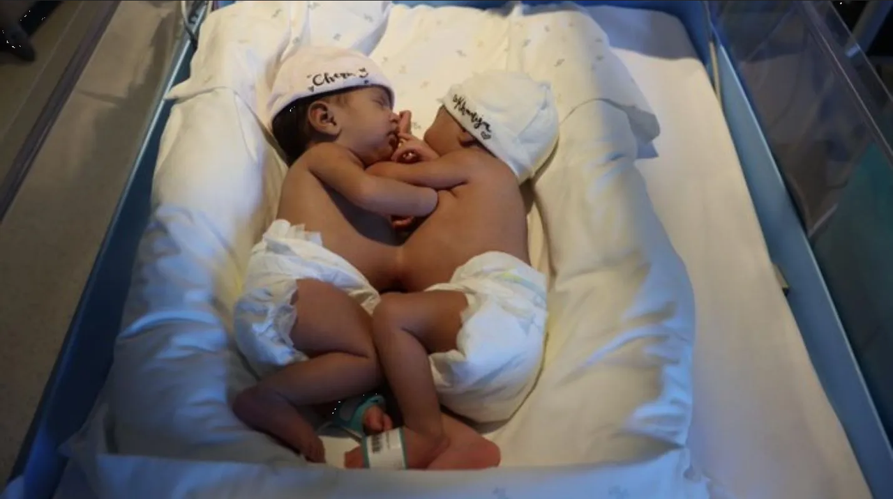 Hermanas siamesas son sepadas en un hospital de Barcelona, España