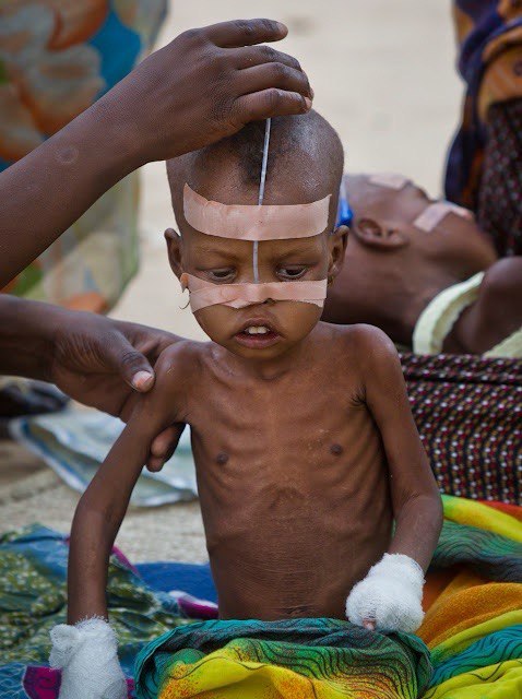 A child receiving nourishment support during a relief intervention