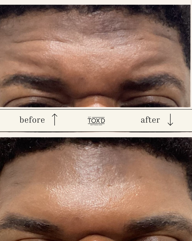 Brotox (Botox for men)