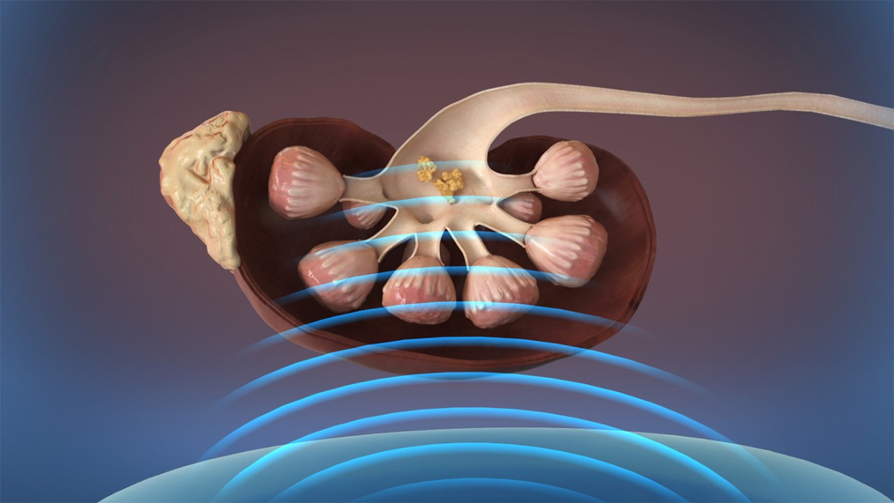 Litotrissia: come utilizzare le onde sonore per rompere i calcoli renali