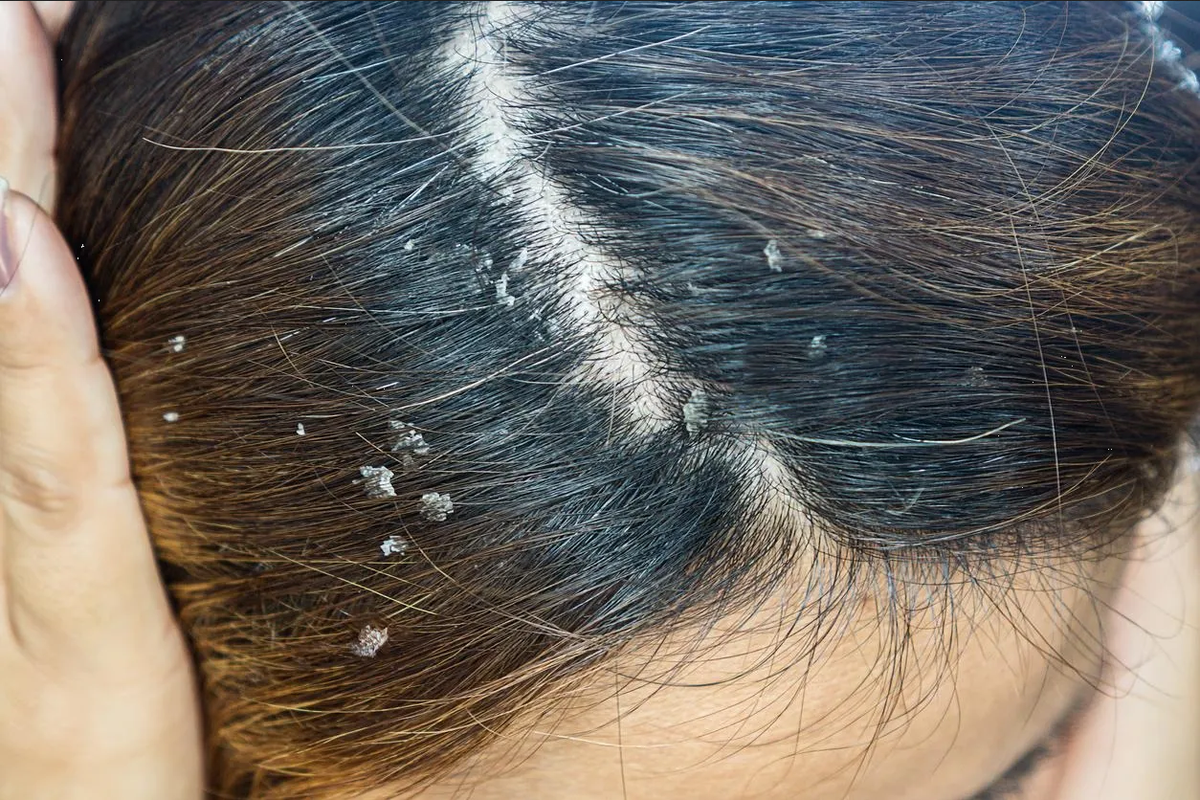 ¿Cómo acabar con la caspa del cabello graso? Aplica aceite de oliva