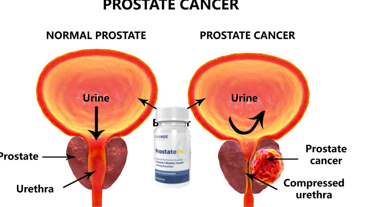 ProstaatP4