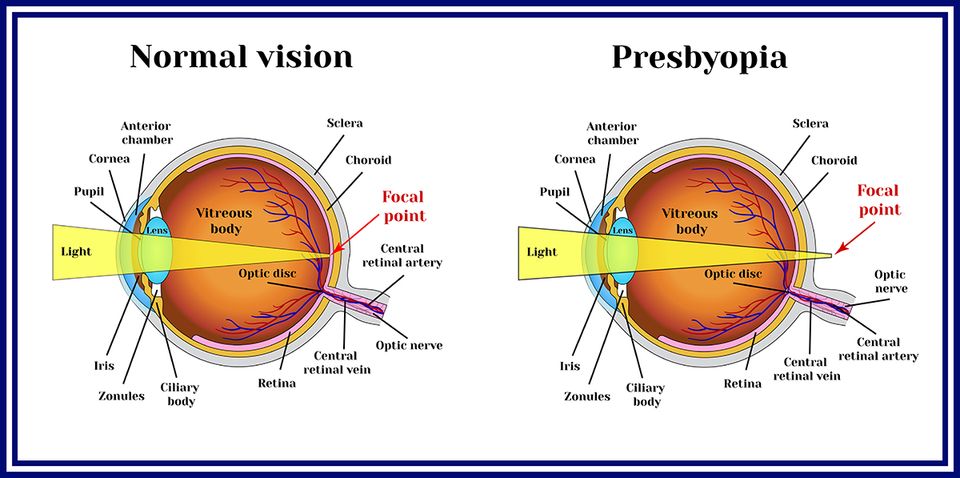เทคโนโลยีเฟมโตเลสิก เพรสบียอน (FemtoLASIK Presbyond) แก้ไขปัญหาสายตายาวตามอายุ