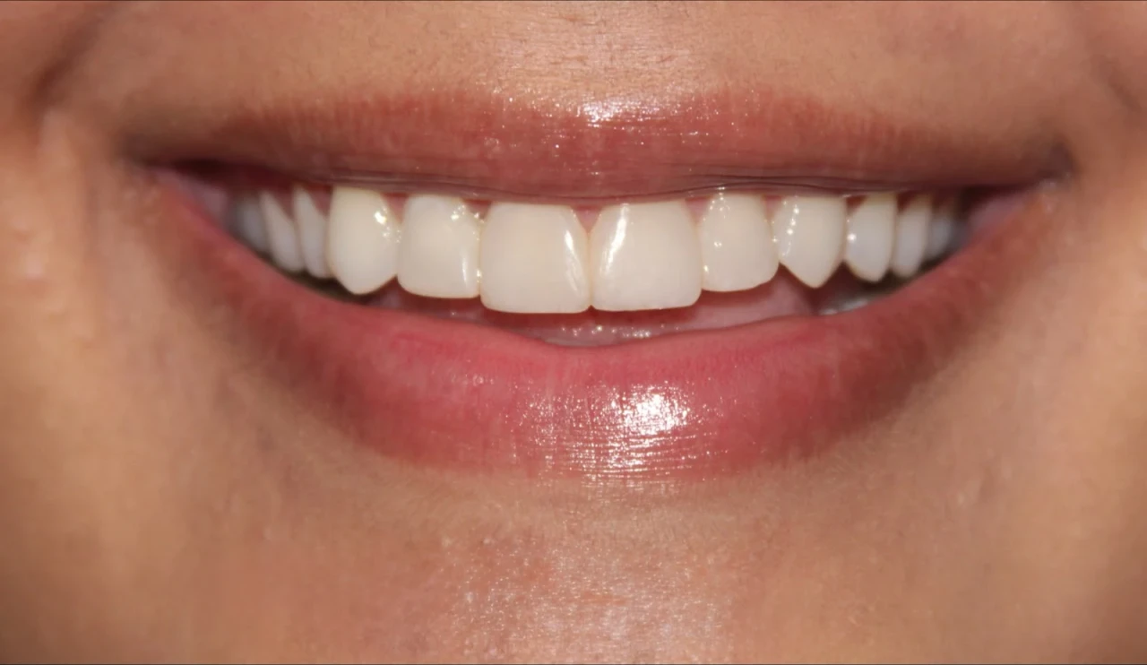 Resultado 3 - Foto Depois Facetas