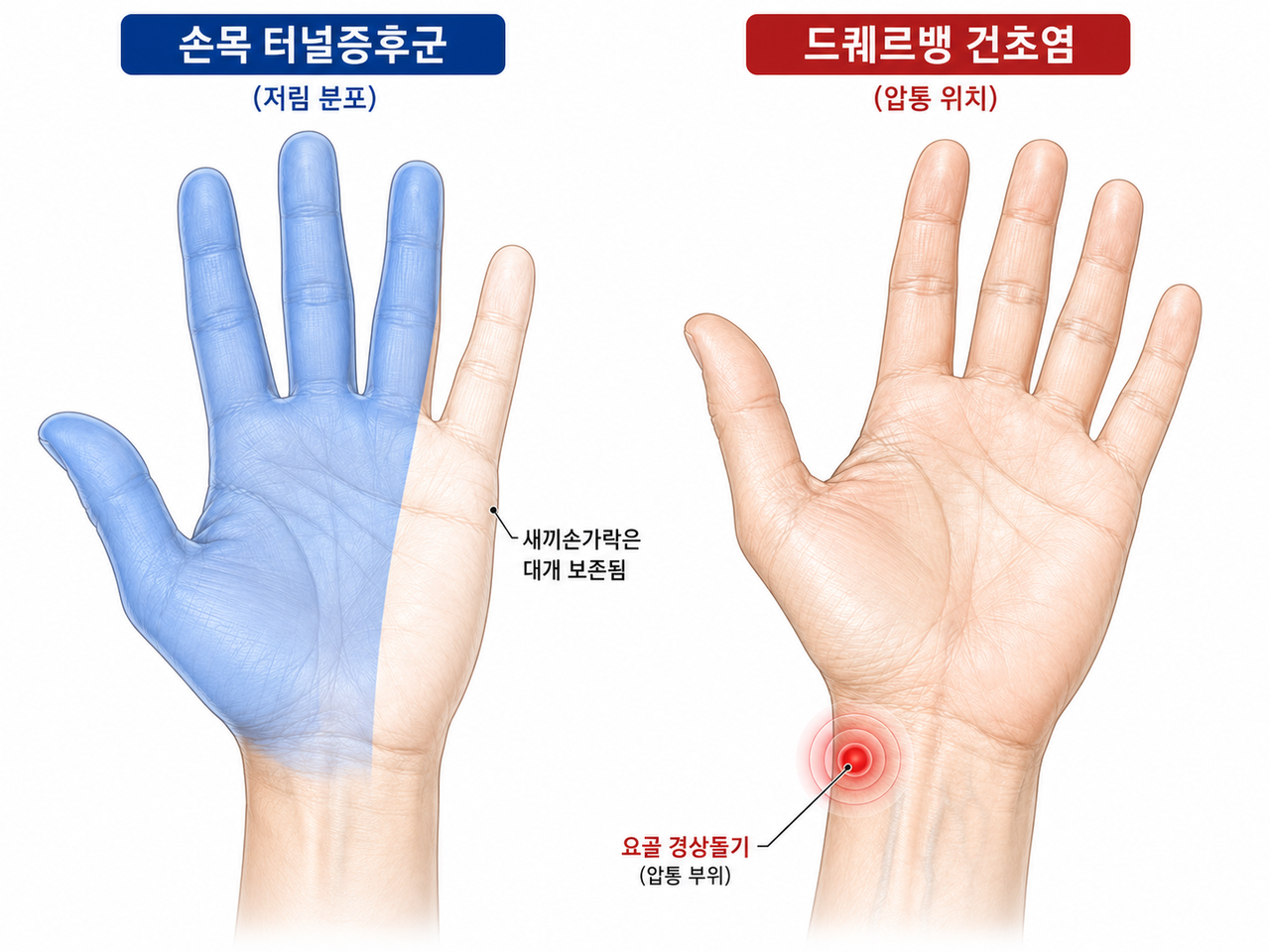 손목터널증후군 저림 분포와 드퀘르벵 건초염 압통 위치 비교
