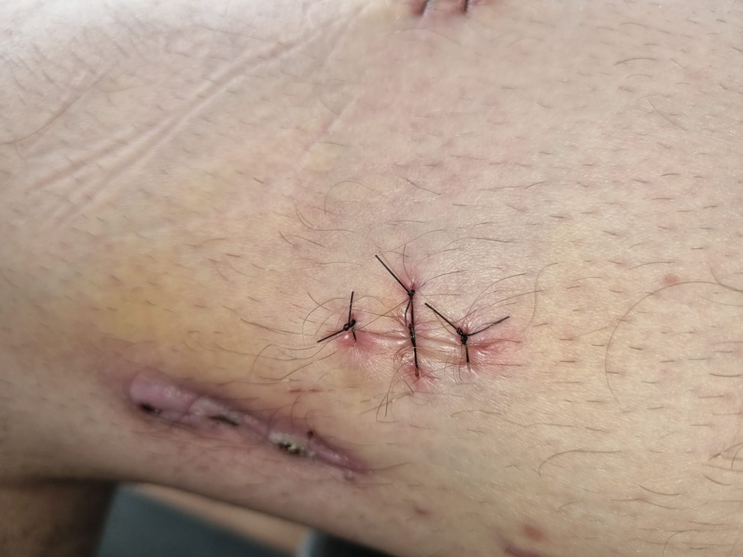 SIDE-LEG-STITCHES2