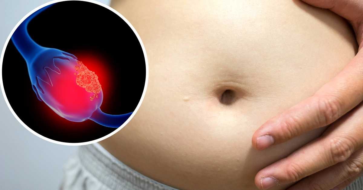 Si tienes esta “sensación incómoda” podría ser indicio de cáncer de ovario