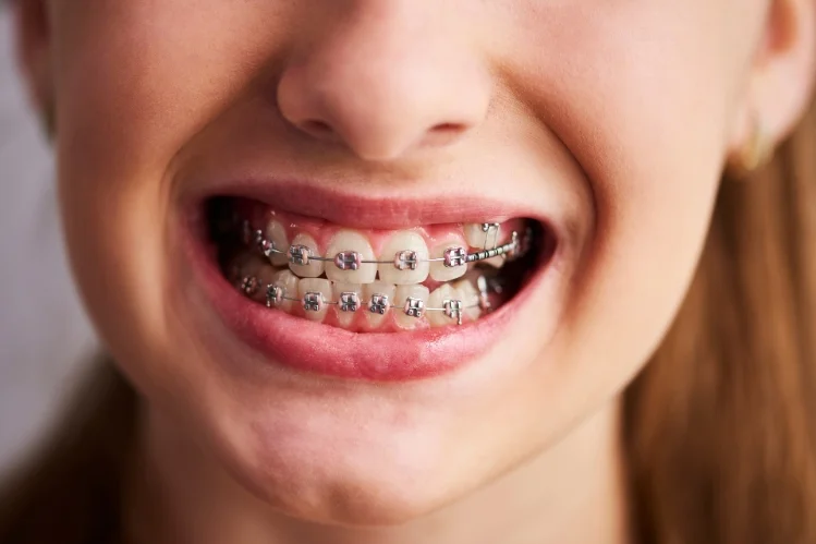 Living with Metal Braces: Your Daily Survival Guide