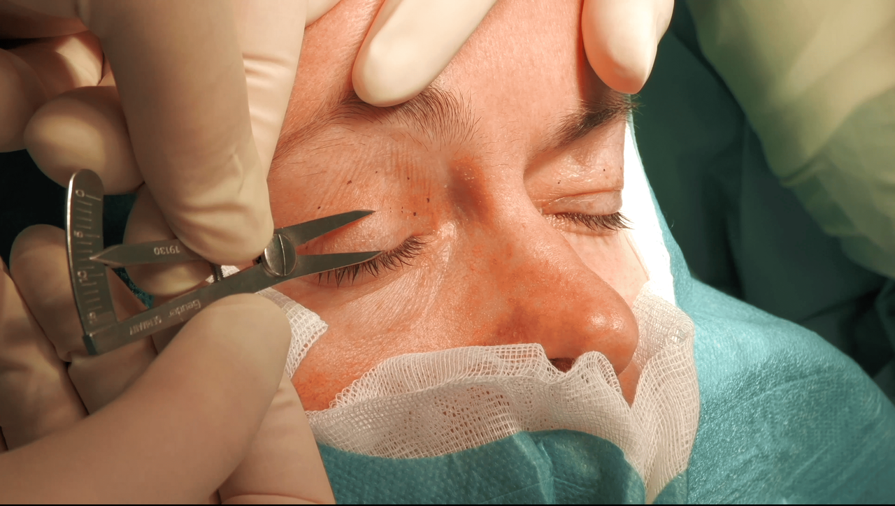 Blepharoplastik Operationskurs