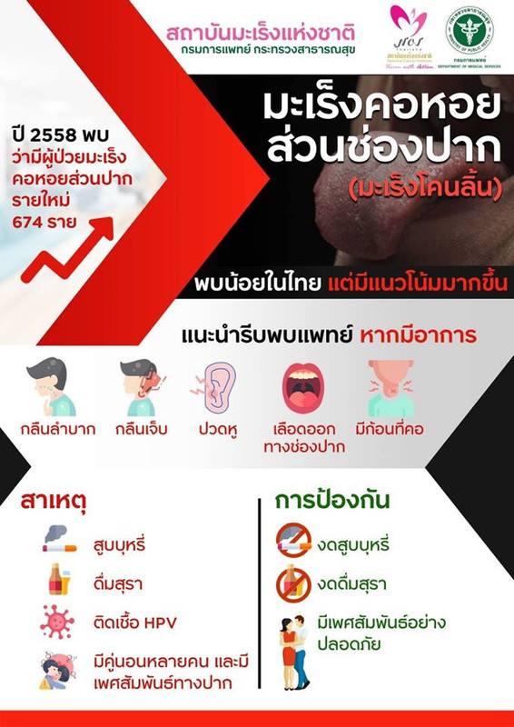 แพทย์ชี้ ?มะเร็งโคนลิ้น? พบน้อยในไทยแต่มีแนวโน้มมากขึ้น แนะให้รีบพบแพทย์หากมีอาการ