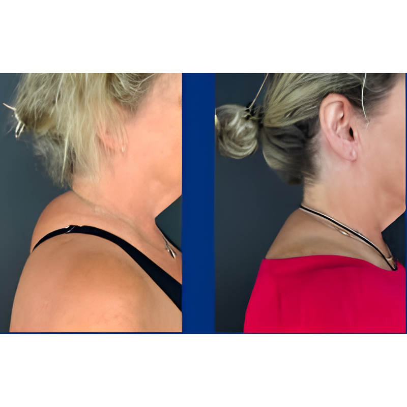 Avant / Après posture