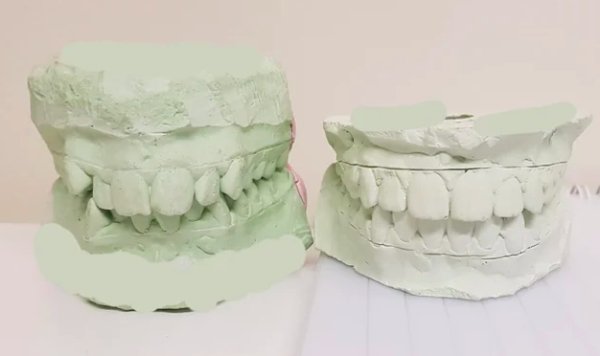 Before-After-15