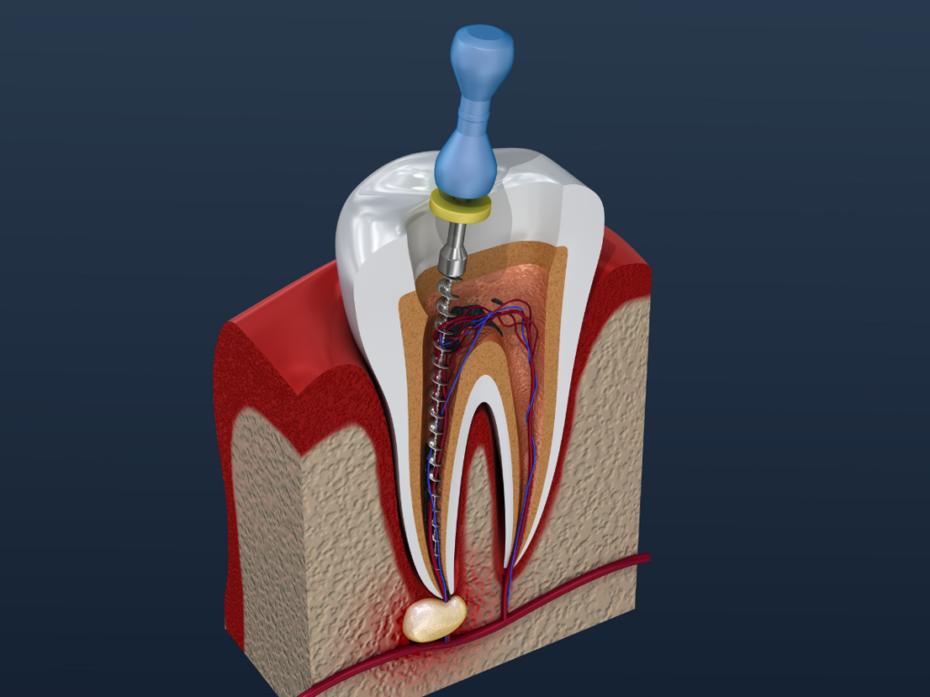 The Benefits of Root Canal Treatment: An In-Depth Look