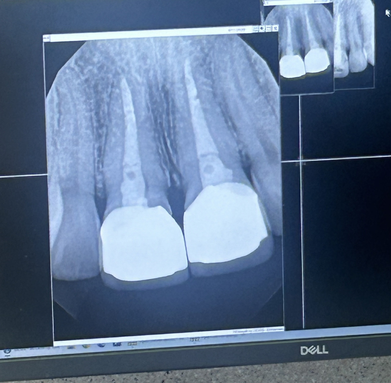 XRAY