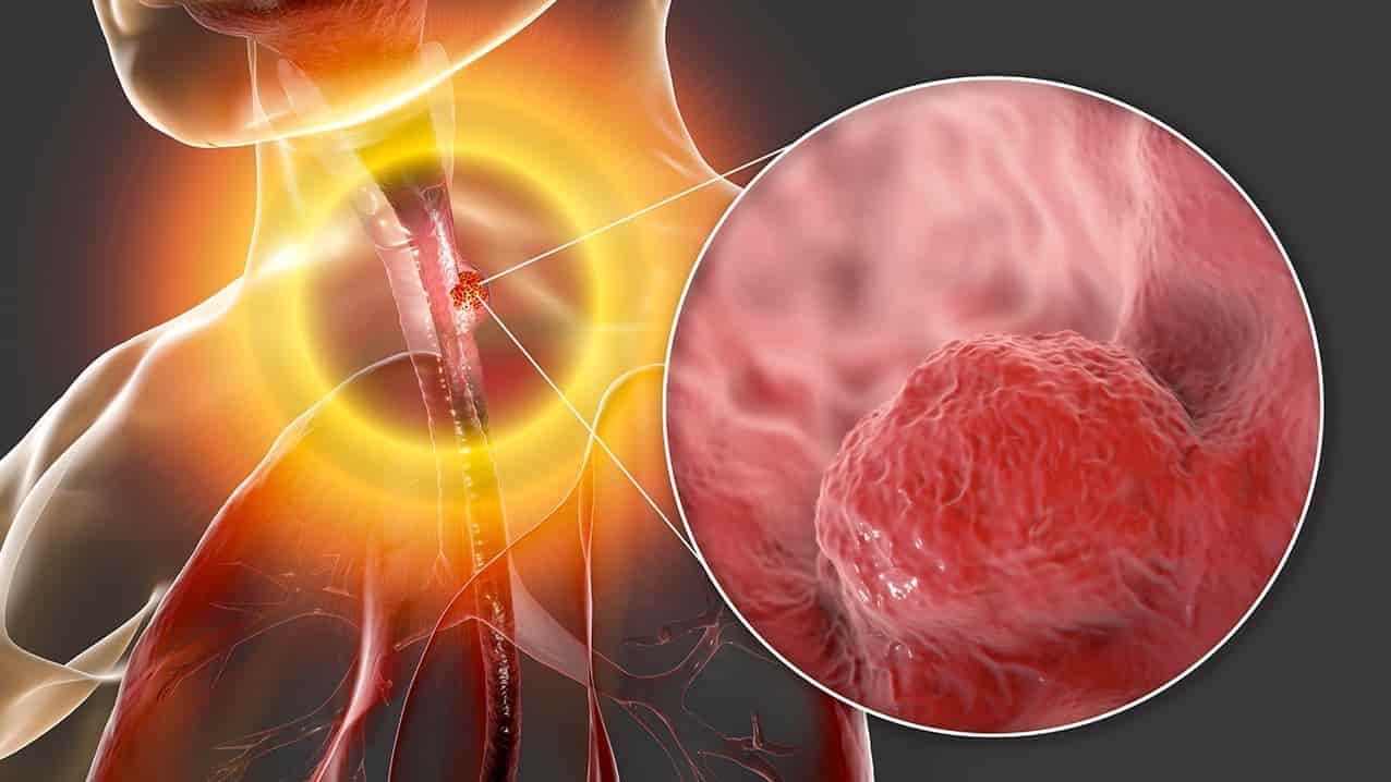 Síntomas del cáncer de esófago ¡No los ignores!