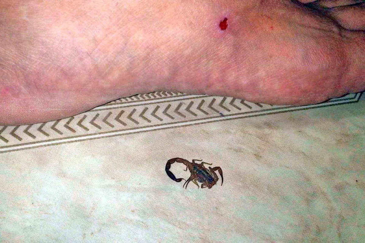 Remedios caseros para la picadura de alacrán