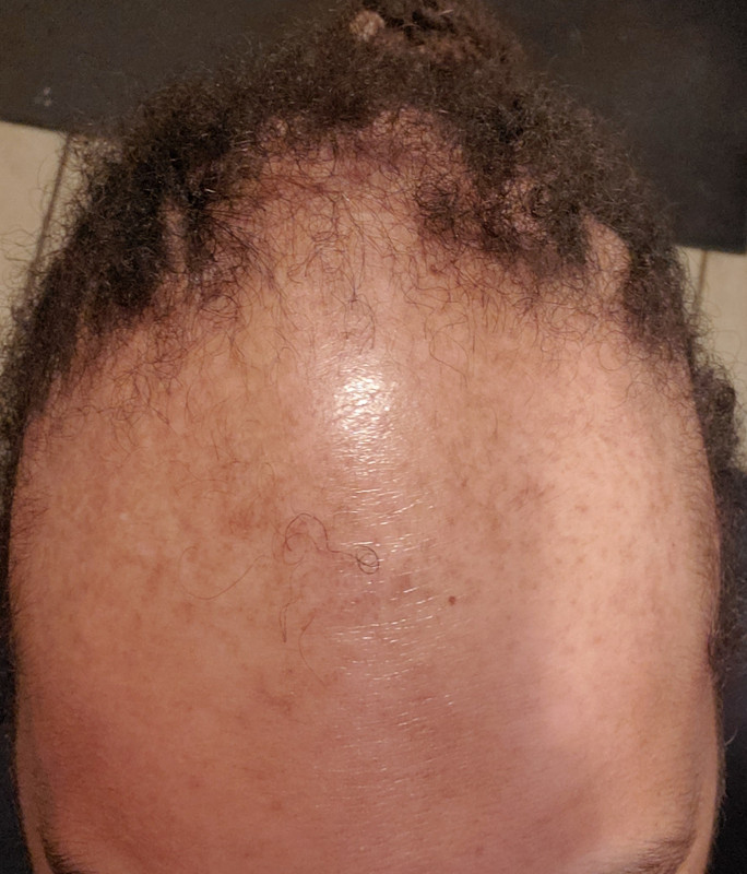 hair-pre-procedure-053731.jpg