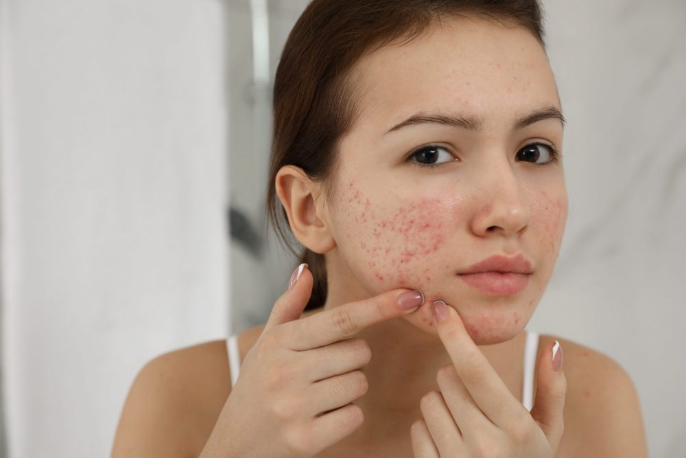 Remove Dark Spots Caused by Pimples