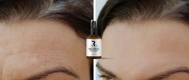 Rechiol crema para la psoriasis