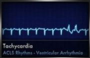 tachycardia