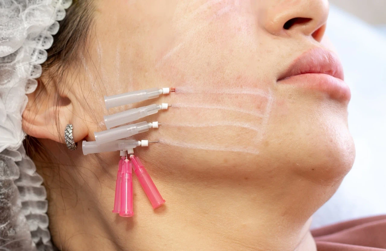 Natural-looking PDO thread results at Let's Face It Med Spa in Denver.