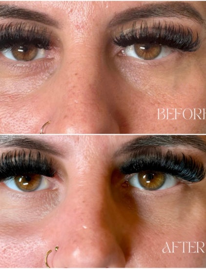 Anti-Wrinkle Injections